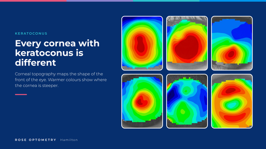 Corneal topography maps from eyes with keratoconus, showing how the steep area of the cornea differs from eye to eye